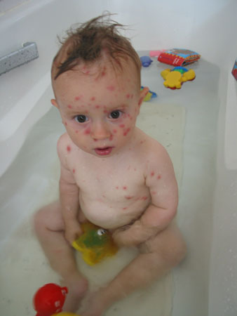 Chicken-pox – varicella