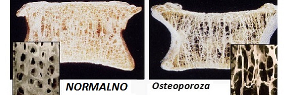 Svjetski dan osteoporoze - 20.10.2016