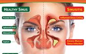 SINUSITIS