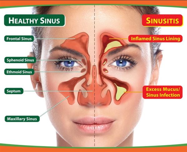 SINUSITIS