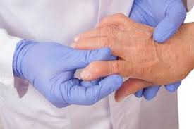 Psorijatični artritis: Uzrok, simptomi i zašto je važno prepoznati ga na vrijeme